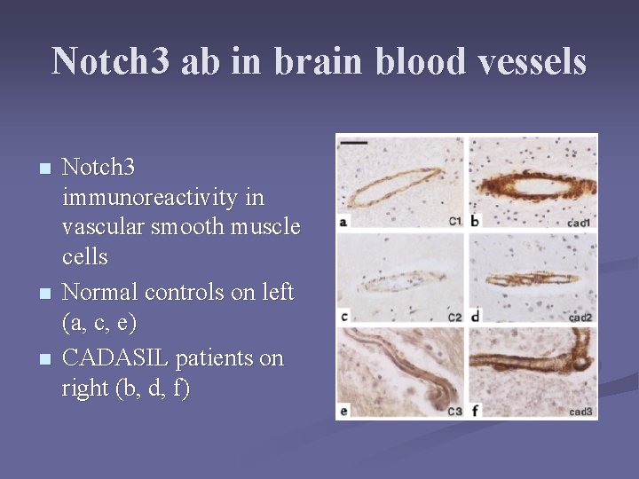 Notch 3 ab in brain blood vessels n n n Notch 3 immunoreactivity in