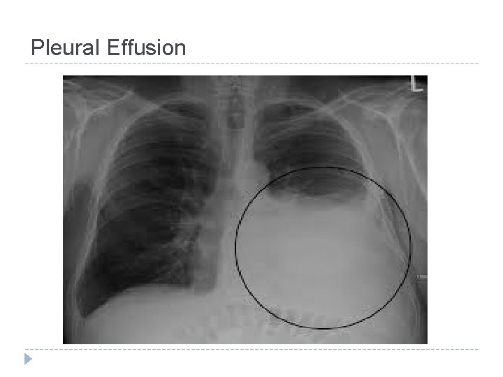 Pleural Effusion 