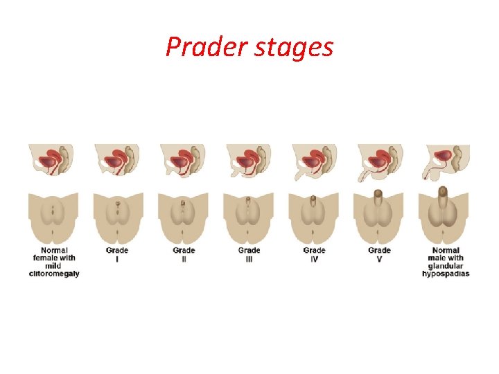 Prader stages 