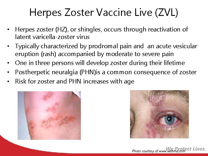 Herpes Zoster Vaccine Live (ZVL) • Herpes zoster (HZ), or shingles, occurs through reactivation