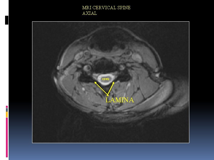 MRI CERVICAL SPINE AXIAL CORD LAMINA 