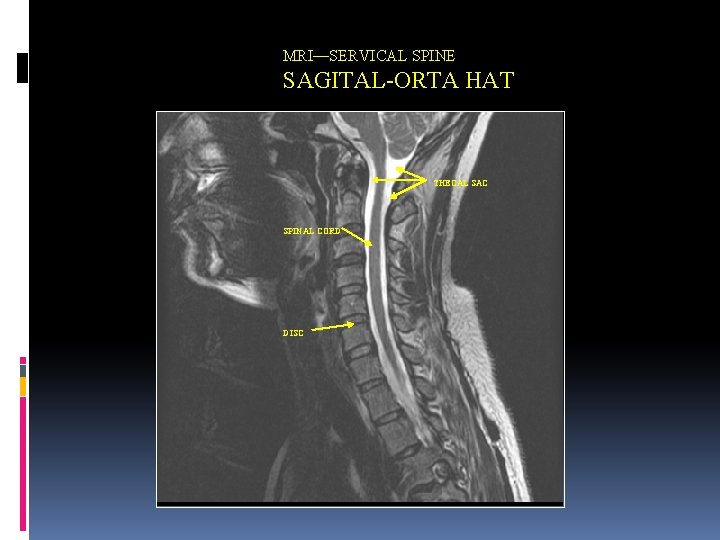 MRI—SERVICAL SPINE SAGITAL-ORTA HAT THECAL SAC SPINAL CORD DISC 