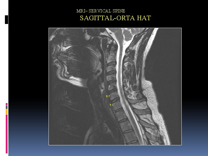 MRI– SERVICAL SPINE SAGITTAL-ORTA HAT C-7 T-1 