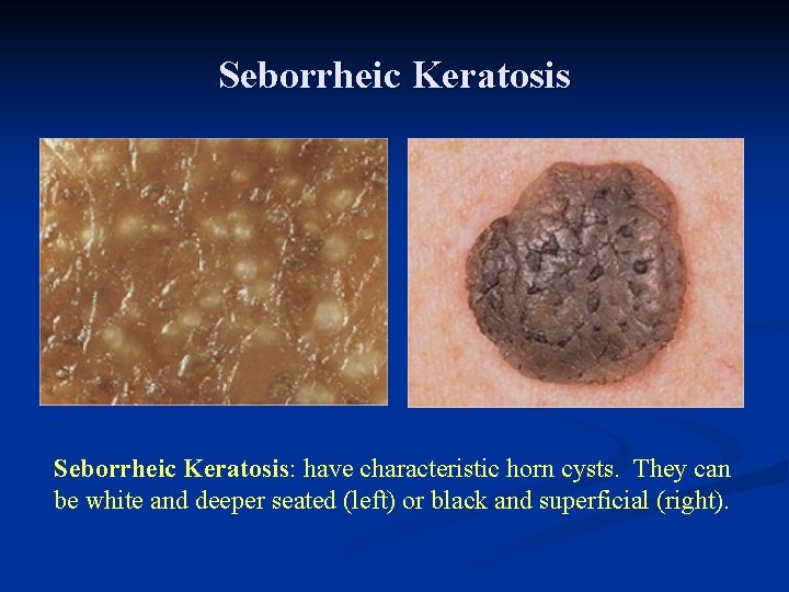 Seborrheic Keratosis: have characteristic horn cysts. They can be white and deeper seated (left) Seborrheic Keratosis: have characteristic horn cysts. They can be white and deeper seated (left)