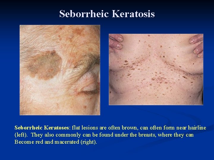 Seborrheic Keratosis Seborrheic Keratoses: flat lesions are often brown, can often form near hairline Seborrheic Keratosis Seborrheic Keratoses: flat lesions are often brown, can often form near hairline