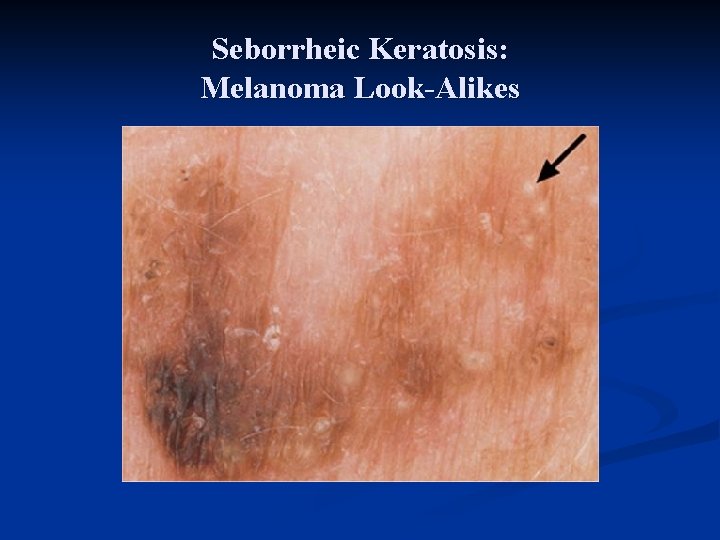 Seborrheic Keratosis: Melanoma Look-Alikes Seborrheic Keratosis: Melanoma Look-Alikes