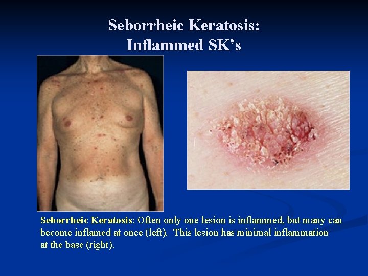 Seborrheic Keratosis: Inflammed SK’s Seborrheic Keratosis: Often only one lesion is inflammed, but many Seborrheic Keratosis: Inflammed SK’s Seborrheic Keratosis: Often only one lesion is inflammed, but many