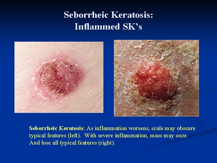 Seborrheic Keratosis: Inflammed SK’s Seborrheic Keratosis: As inflammation worsens, scale may obscure typical features Seborrheic Keratosis: Inflammed SK’s Seborrheic Keratosis: As inflammation worsens, scale may obscure typical features