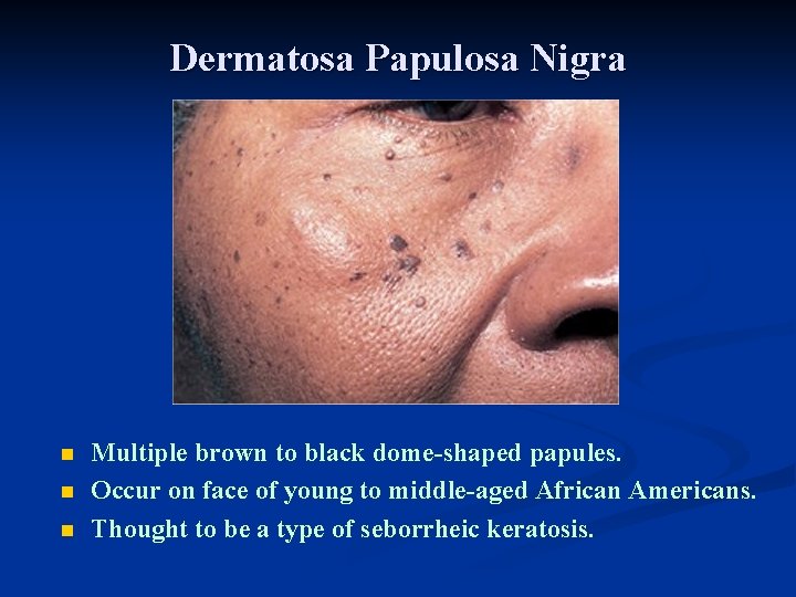 Dermatosa Papulosa Nigra n n n Multiple brown to black dome-shaped papules. Occur on Dermatosa Papulosa Nigra n n n Multiple brown to black dome-shaped papules. Occur on