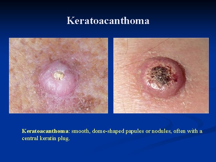 Keratoacanthoma: smooth, dome-shaped papules or nodules, often with a central keratin plug. Keratoacanthoma: smooth, dome-shaped papules or nodules, often with a central keratin plug.