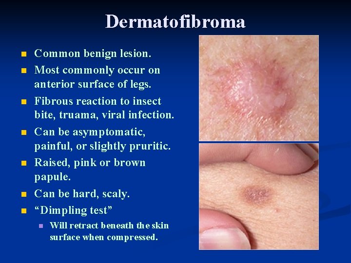 Dermatofibroma n n n n Common benign lesion. Most commonly occur on anterior surface Dermatofibroma n n n n Common benign lesion. Most commonly occur on anterior surface