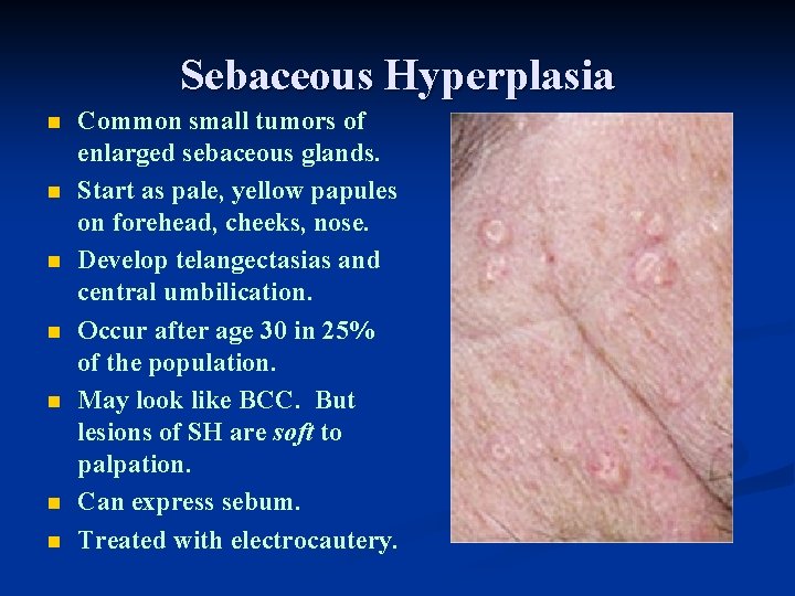 Sebaceous Hyperplasia n n n n Common small tumors of enlarged sebaceous glands. Start Sebaceous Hyperplasia n n n n Common small tumors of enlarged sebaceous glands. Start