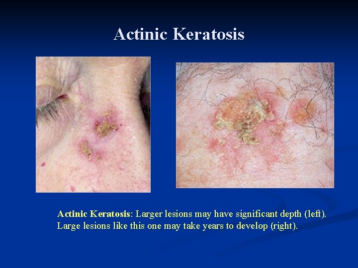 Actinic Keratosis: Larger lesions may have significant depth (left). Large lesions like this one Actinic Keratosis: Larger lesions may have significant depth (left). Large lesions like this one