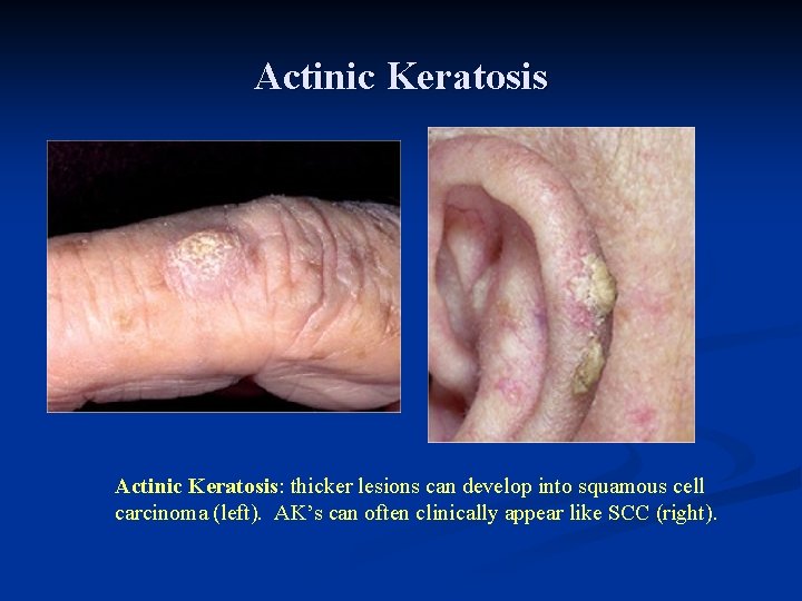 Actinic Keratosis: thicker lesions can develop into squamous cell carcinoma (left). AK’s can often Actinic Keratosis: thicker lesions can develop into squamous cell carcinoma (left). AK’s can often