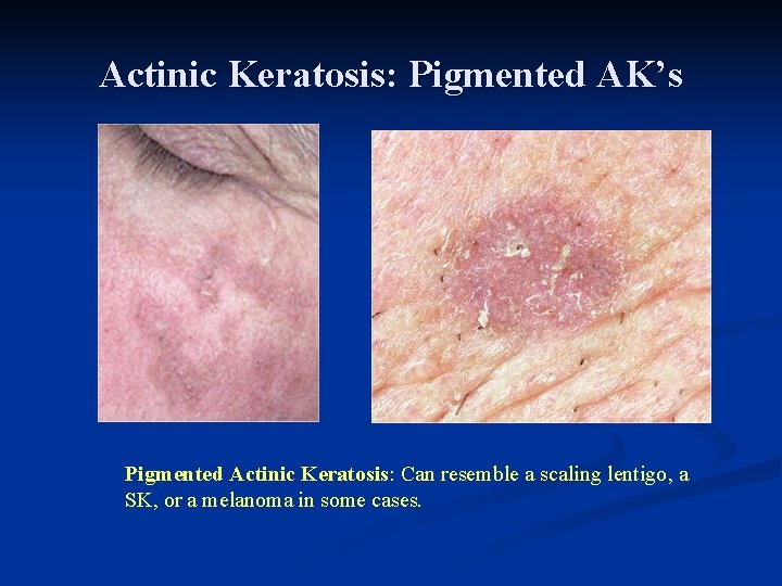 Actinic Keratosis: Pigmented AK’s Pigmented Actinic Keratosis: Can resemble a scaling lentigo, a SK, Actinic Keratosis: Pigmented AK’s Pigmented Actinic Keratosis: Can resemble a scaling lentigo, a SK,