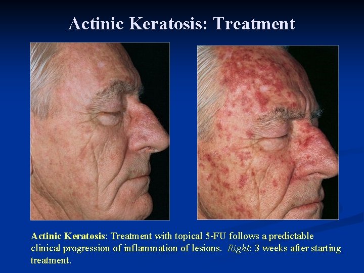 Actinic Keratosis: Treatment with topical 5 -FU follows a predictable clinical progression of inflammation Actinic Keratosis: Treatment with topical 5 -FU follows a predictable clinical progression of inflammation