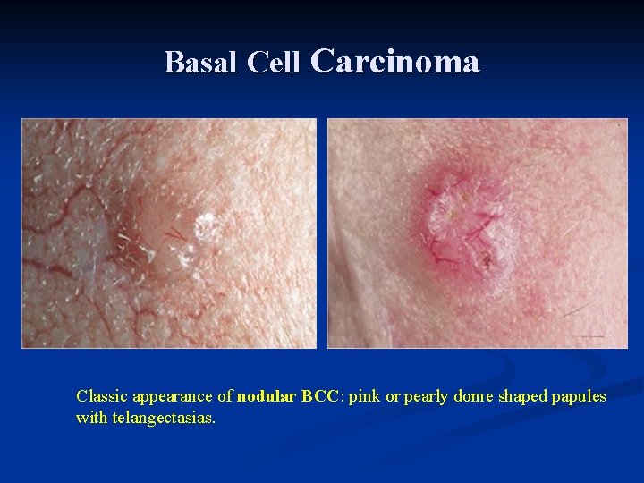 Basal Cell Carcinoma Classic appearance of nodular BCC: pink or pearly dome shaped papules Basal Cell Carcinoma Classic appearance of nodular BCC: pink or pearly dome shaped papules