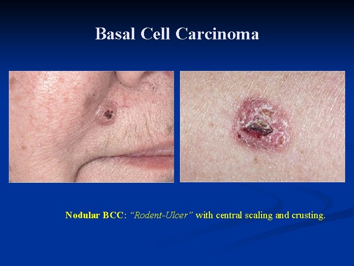 Basal Cell Carcinoma Nodular BCC: “Rodent-Ulcer” with central scaling and crusting. Basal Cell Carcinoma Nodular BCC: “Rodent-Ulcer” with central scaling and crusting.
