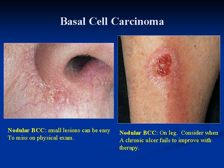 Basal Cell Carcinoma Nodular BCC: small lesions can be easy To miss on physical Basal Cell Carcinoma Nodular BCC: small lesions can be easy To miss on physical