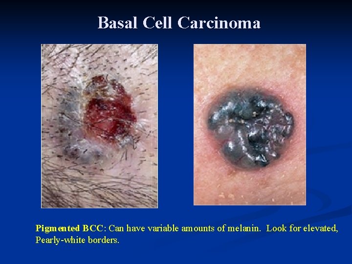 Basal Cell Carcinoma Pigmented BCC: Can have variable amounts of melanin. Look for elevated, Basal Cell Carcinoma Pigmented BCC: Can have variable amounts of melanin. Look for elevated,