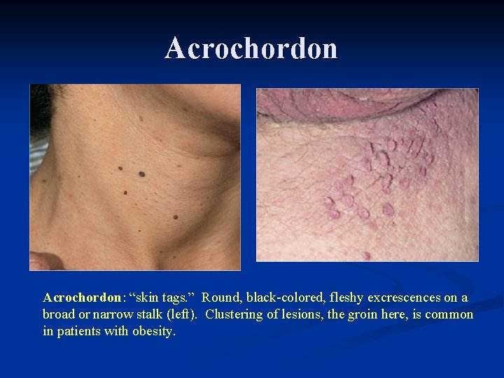 Acrochordon: “skin tags. ” Round, black-colored, fleshy excrescences on a broad or narrow stalk Acrochordon: “skin tags. ” Round, black-colored, fleshy excrescences on a broad or narrow stalk