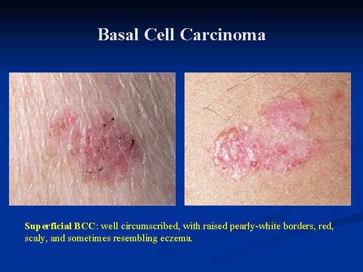 Basal Cell Carcinoma Superficial BCC: well circumscribed, with raised pearly-white borders, red, scaly, and Basal Cell Carcinoma Superficial BCC: well circumscribed, with raised pearly-white borders, red, scaly, and
