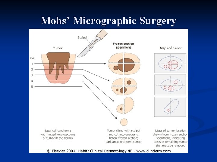 Mohs’ Micrographic Surgery Mohs’ Micrographic Surgery