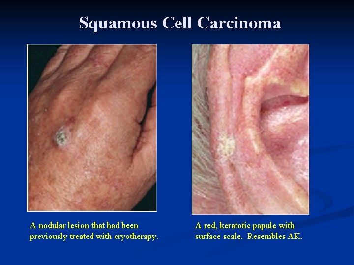 Squamous Cell Carcinoma A nodular lesion that had been previously treated with cryotherapy. A Squamous Cell Carcinoma A nodular lesion that had been previously treated with cryotherapy. A