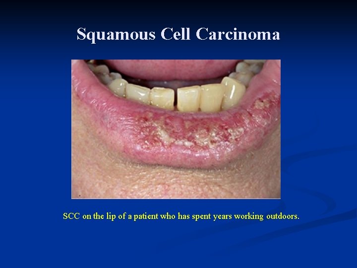 Squamous Cell Carcinoma SCC on the lip of a patient who has spent years Squamous Cell Carcinoma SCC on the lip of a patient who has spent years