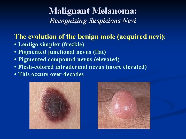 Malignant Melanoma: Recognizing Suspicious Nevi The evolution of the benign mole (acquired nevi): • Malignant Melanoma: Recognizing Suspicious Nevi The evolution of the benign mole (acquired nevi): •