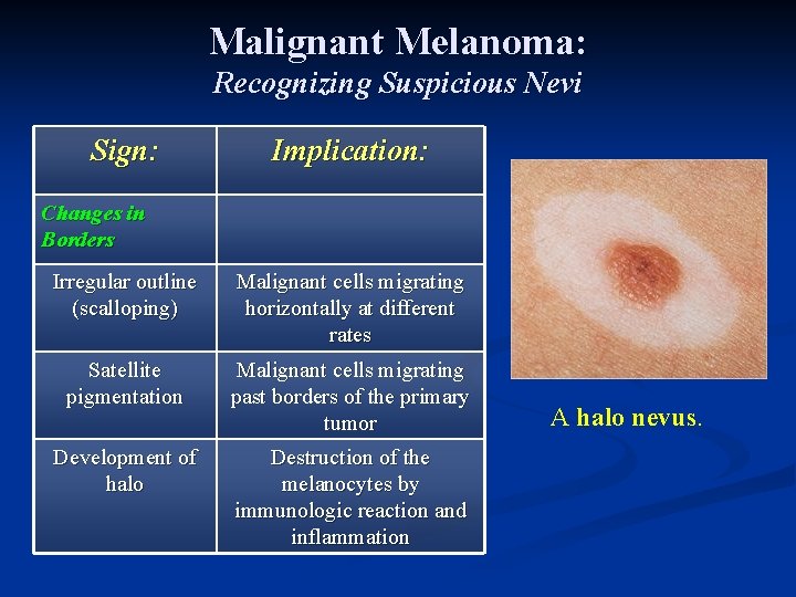 Malignant Melanoma: Recognizing Suspicious Nevi Sign: Implication: Changes in Borders Irregular outline (scalloping) Malignant Malignant Melanoma: Recognizing Suspicious Nevi Sign: Implication: Changes in Borders Irregular outline (scalloping) Malignant