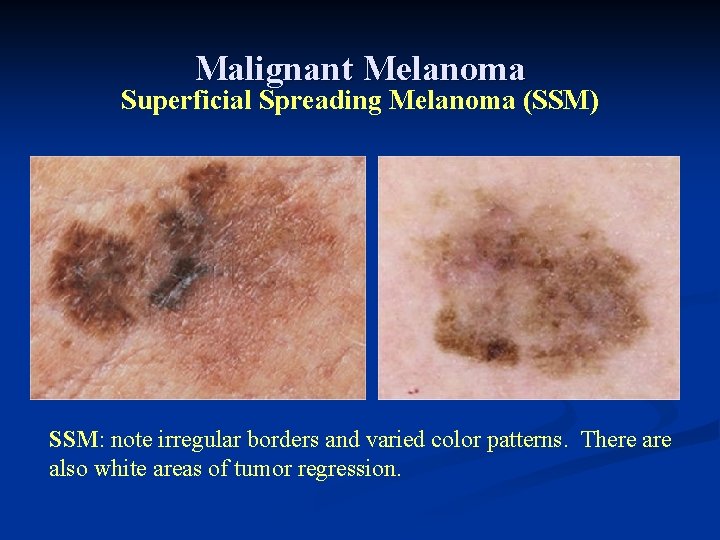 Malignant Melanoma Superficial Spreading Melanoma (SSM) SSM: note irregular borders and varied color patterns. Malignant Melanoma Superficial Spreading Melanoma (SSM) SSM: note irregular borders and varied color patterns.