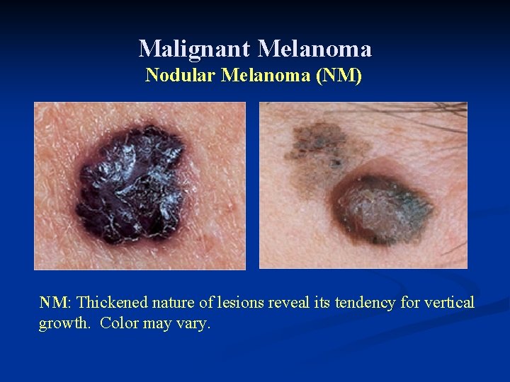 Malignant Melanoma Nodular Melanoma (NM) NM: Thickened nature of lesions reveal its tendency for Malignant Melanoma Nodular Melanoma (NM) NM: Thickened nature of lesions reveal its tendency for