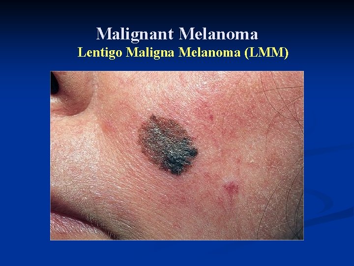 Malignant Melanoma Lentigo Maligna Melanoma (LMM) Malignant Melanoma Lentigo Maligna Melanoma (LMM)