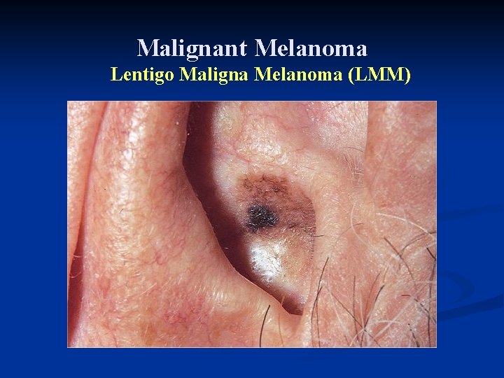 Malignant Melanoma Lentigo Maligna Melanoma (LMM) Malignant Melanoma Lentigo Maligna Melanoma (LMM)
