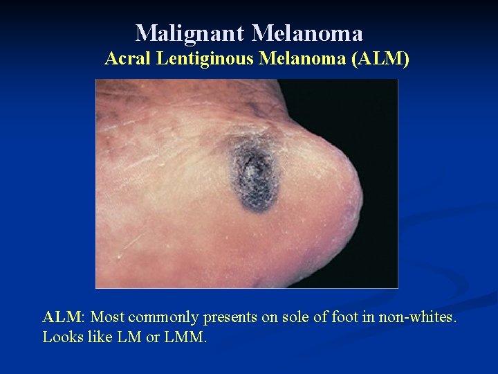 Malignant Melanoma Acral Lentiginous Melanoma (ALM) ALM: Most commonly presents on sole of foot Malignant Melanoma Acral Lentiginous Melanoma (ALM) ALM: Most commonly presents on sole of foot