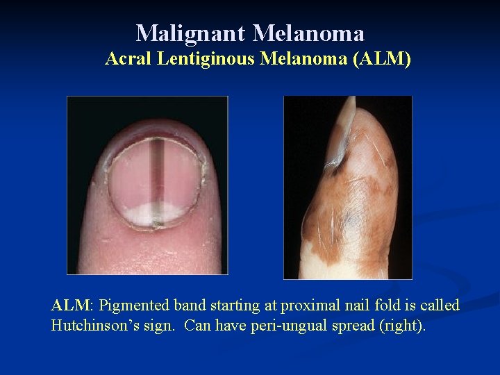 Acral lentiginous melanoma