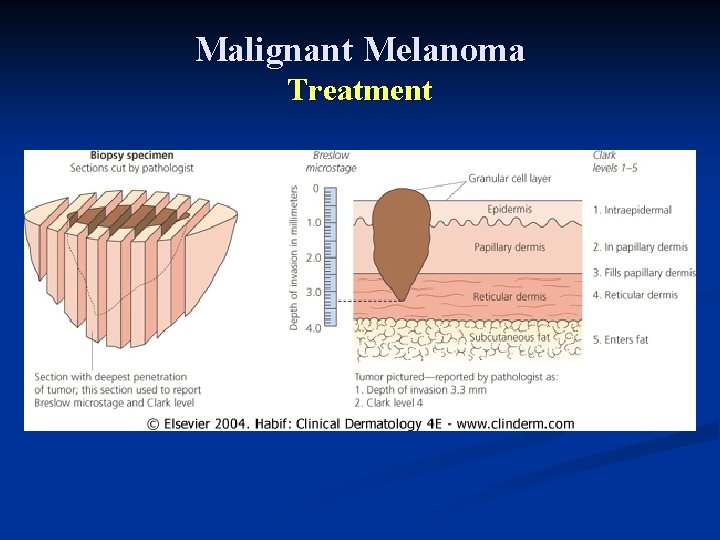 Malignant Melanoma Treatment Malignant Melanoma Treatment