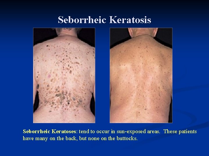 Seborrheic Keratosis Seborrheic Keratoses: tend to occur in sun-exposed areas. These patients have many Seborrheic Keratosis Seborrheic Keratoses: tend to occur in sun-exposed areas. These patients have many