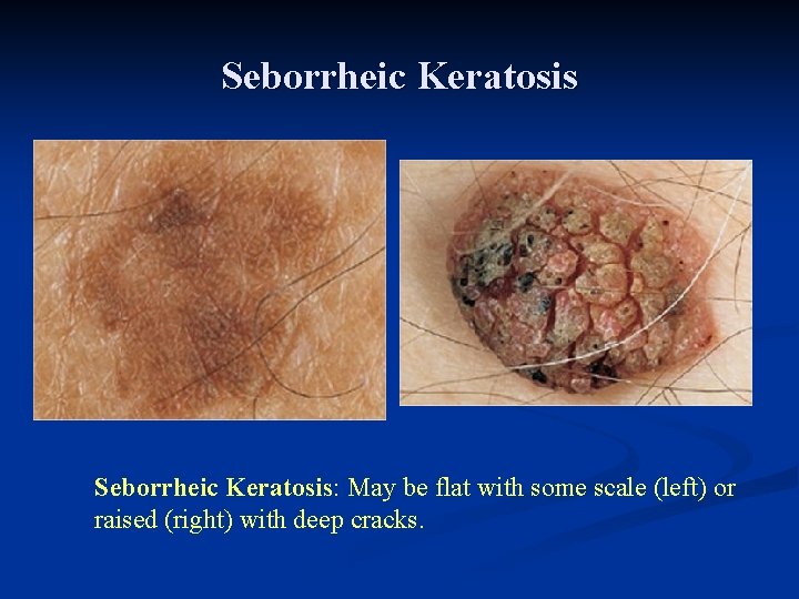 Seborrheic Keratosis: May be flat with some scale (left) or raised (right) with deep Seborrheic Keratosis: May be flat with some scale (left) or raised (right) with deep