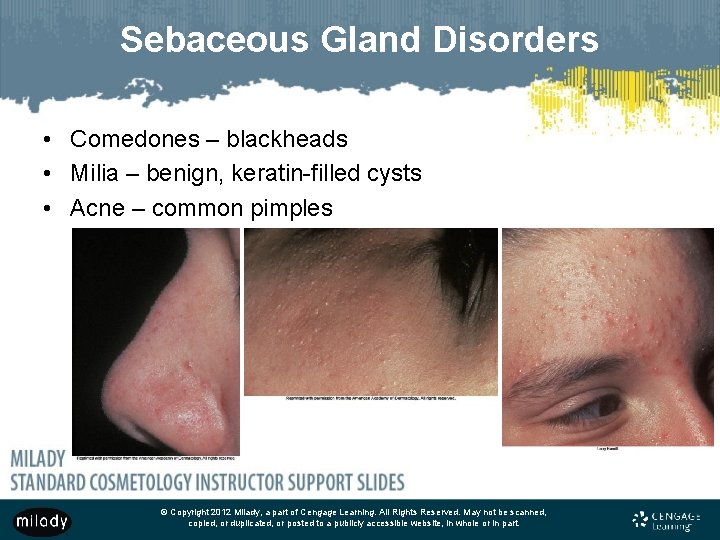 Sebaceous Gland Disorders • Comedones – blackheads • Milia – benign, keratin-filled cysts •