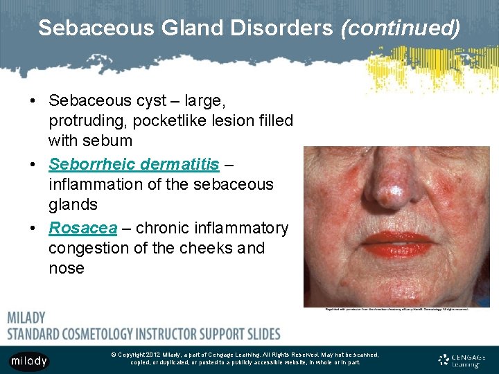 Sebaceous Gland Disorders (continued) • Sebaceous cyst – large, protruding, pocketlike lesion filled with