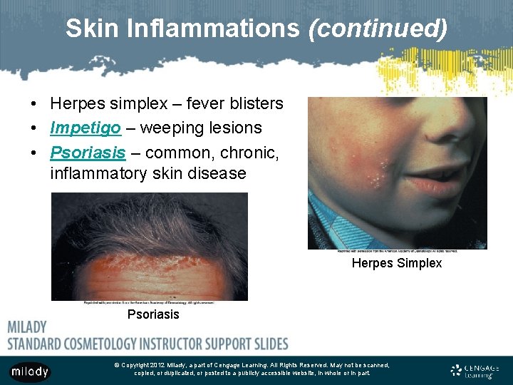 Skin Inflammations (continued) • Herpes simplex – fever blisters • Impetigo – weeping lesions