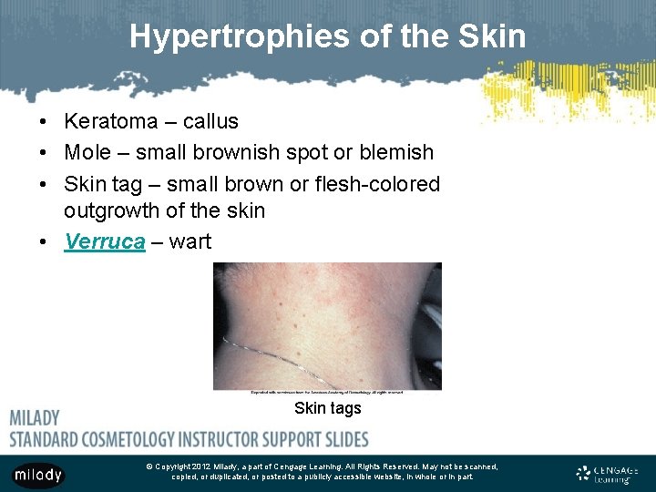 Hypertrophies of the Skin • Keratoma – callus • Mole – small brownish spot