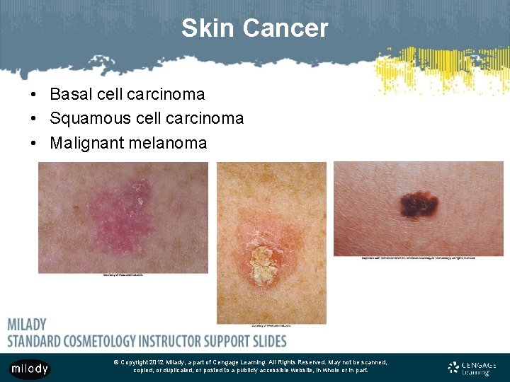 Skin Cancer • Basal cell carcinoma • Squamous cell carcinoma • Malignant melanoma ©