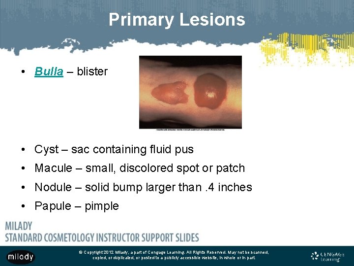 Primary Lesions • Bulla – blister • Cyst – sac containing fluid pus •