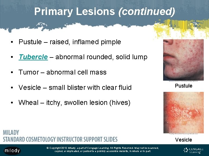 Primary Lesions (continued) • Pustule – raised, inflamed pimple • Tubercle – abnormal rounded,