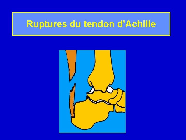 Ruptures du tendon d’Achille 