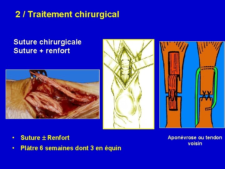 2 / Traitement chirurgical Suture chirurgicale Suture + renfort • Suture Renfort • Plâtre