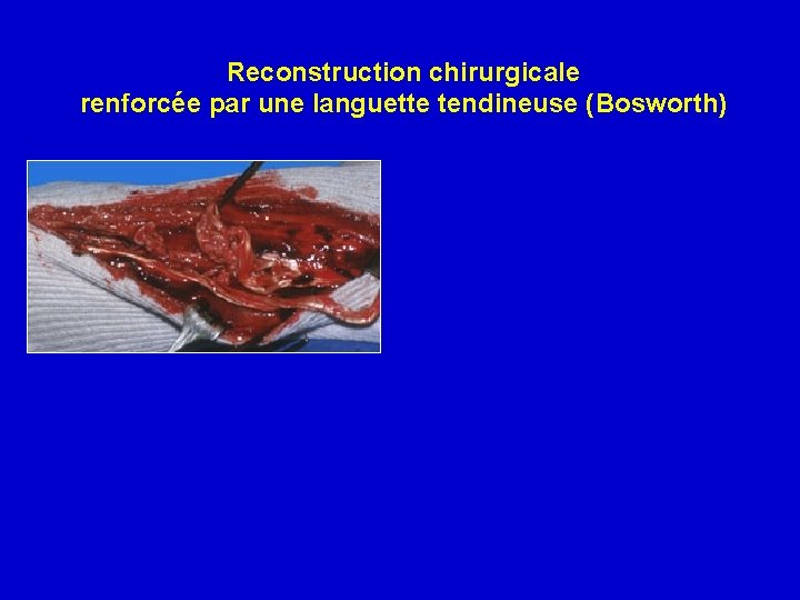 Reconstruction chirurgicale renforcée par une languette tendineuse (Bosworth) 